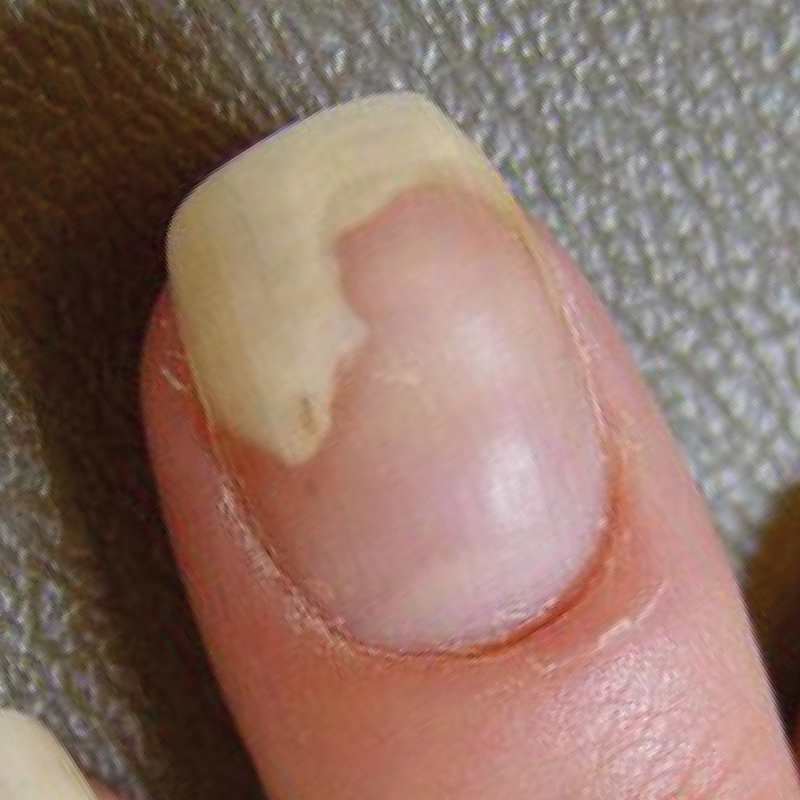 Unha com descolamento