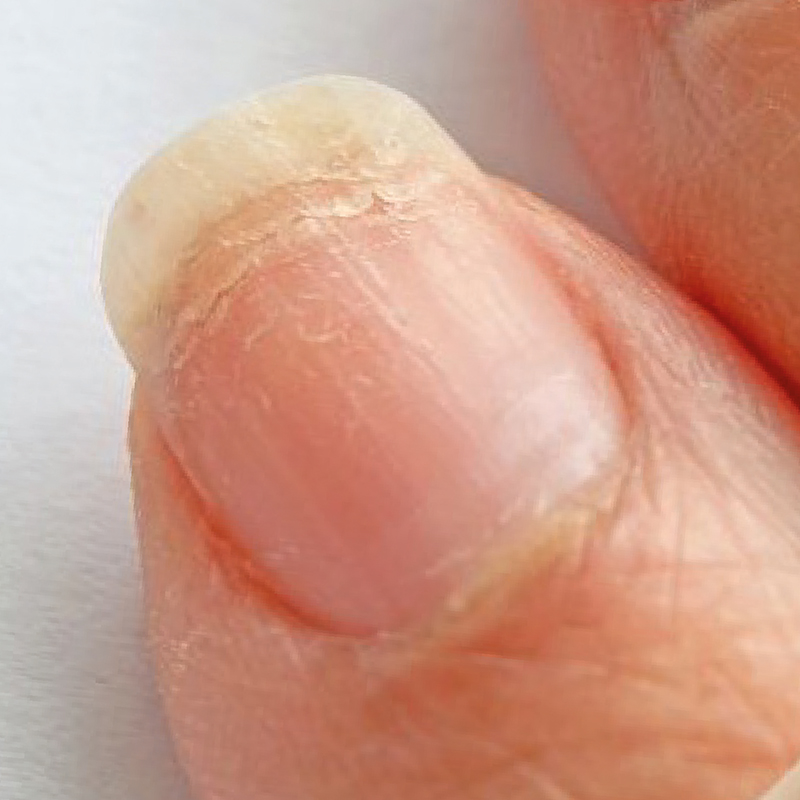 Unhas ressecadas, escamadas ou rachadas