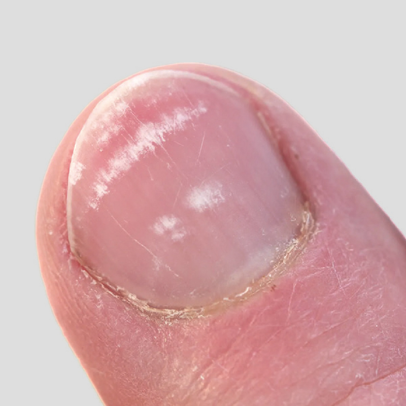 Unhas com manchas brancas (Leuconiquia)