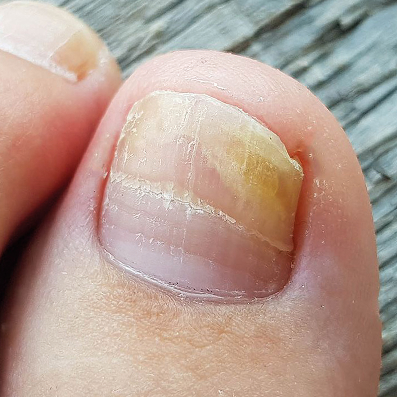 Unhas com fungos e micose