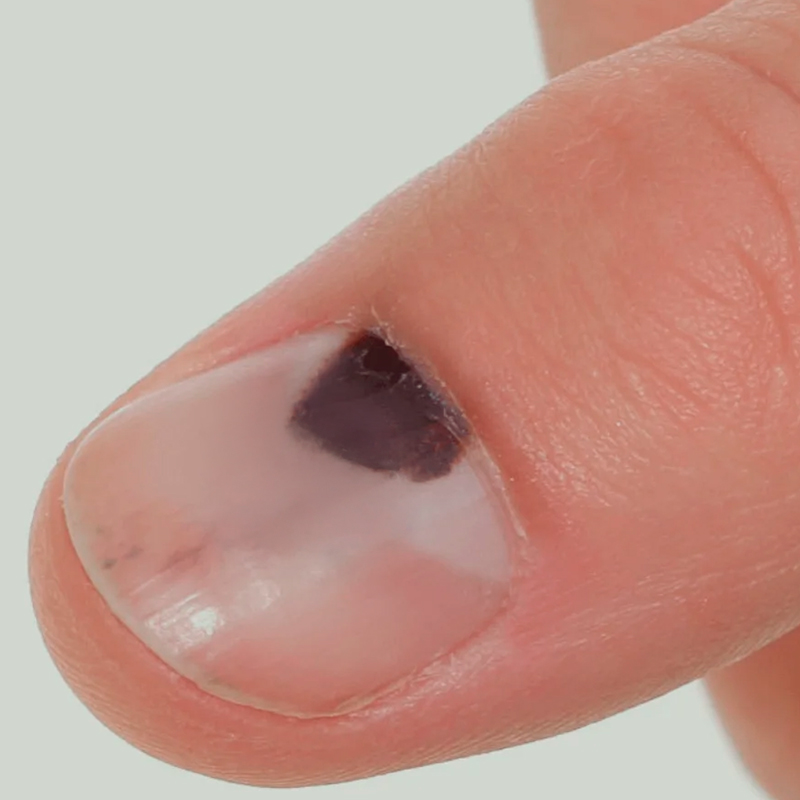 Pequenos traumas na matriz (Batidas)