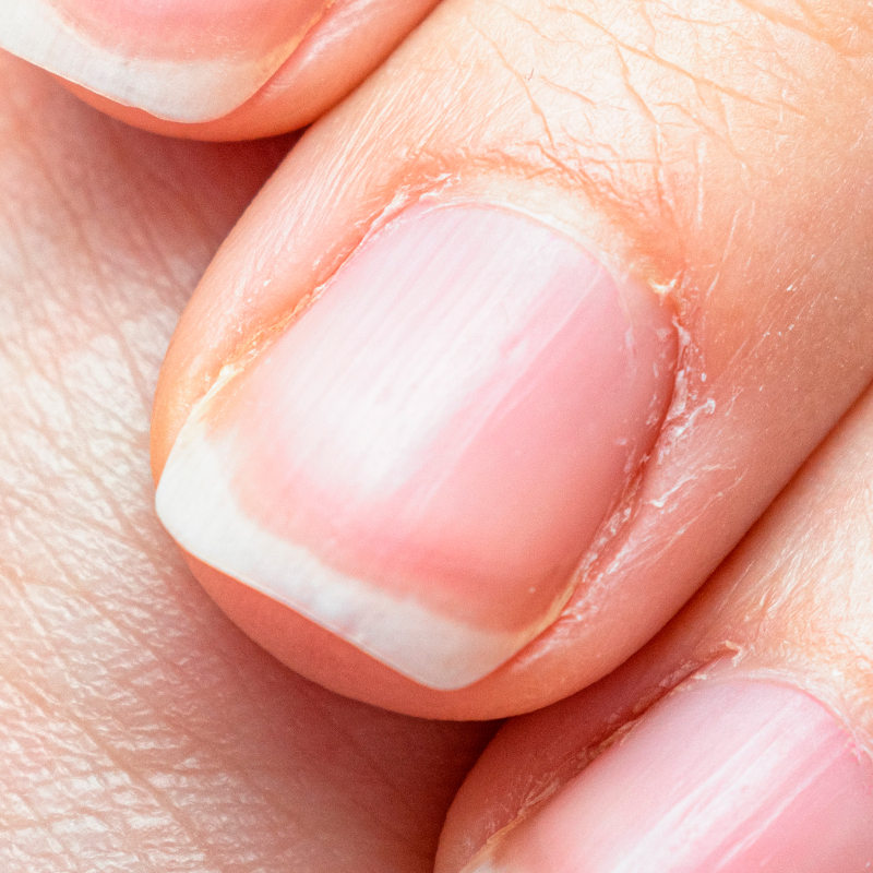 Cutícula Ressecadas / Ásperas