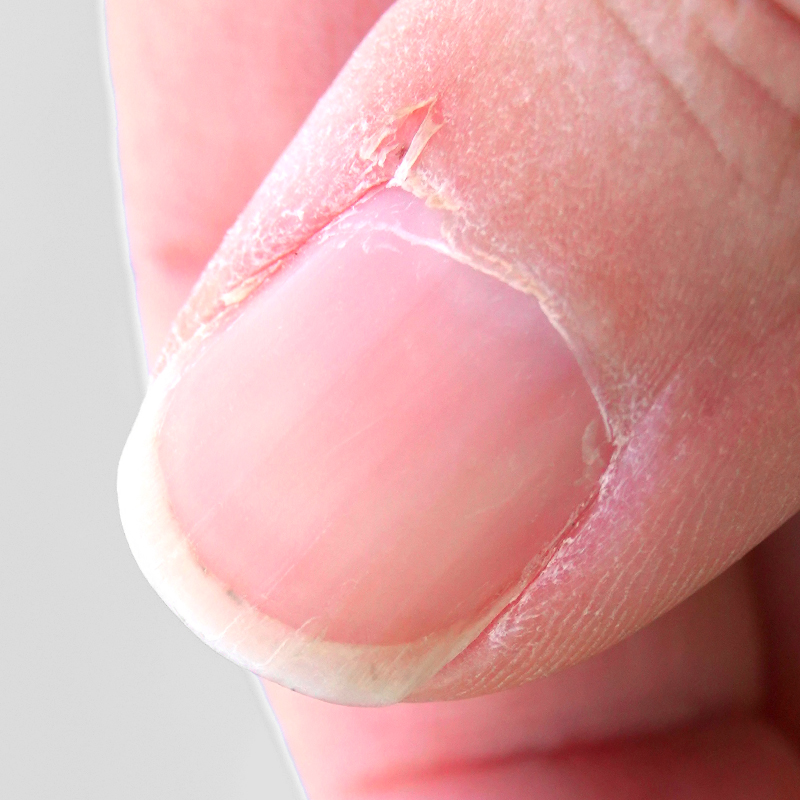 Cutícula Pele soltas / Rachaduras